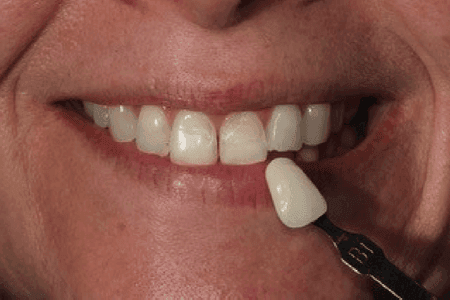 Restorative dental teeth